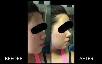 NoseSecret Before and After Photo