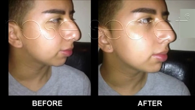 NoseSecret Before and After Photo